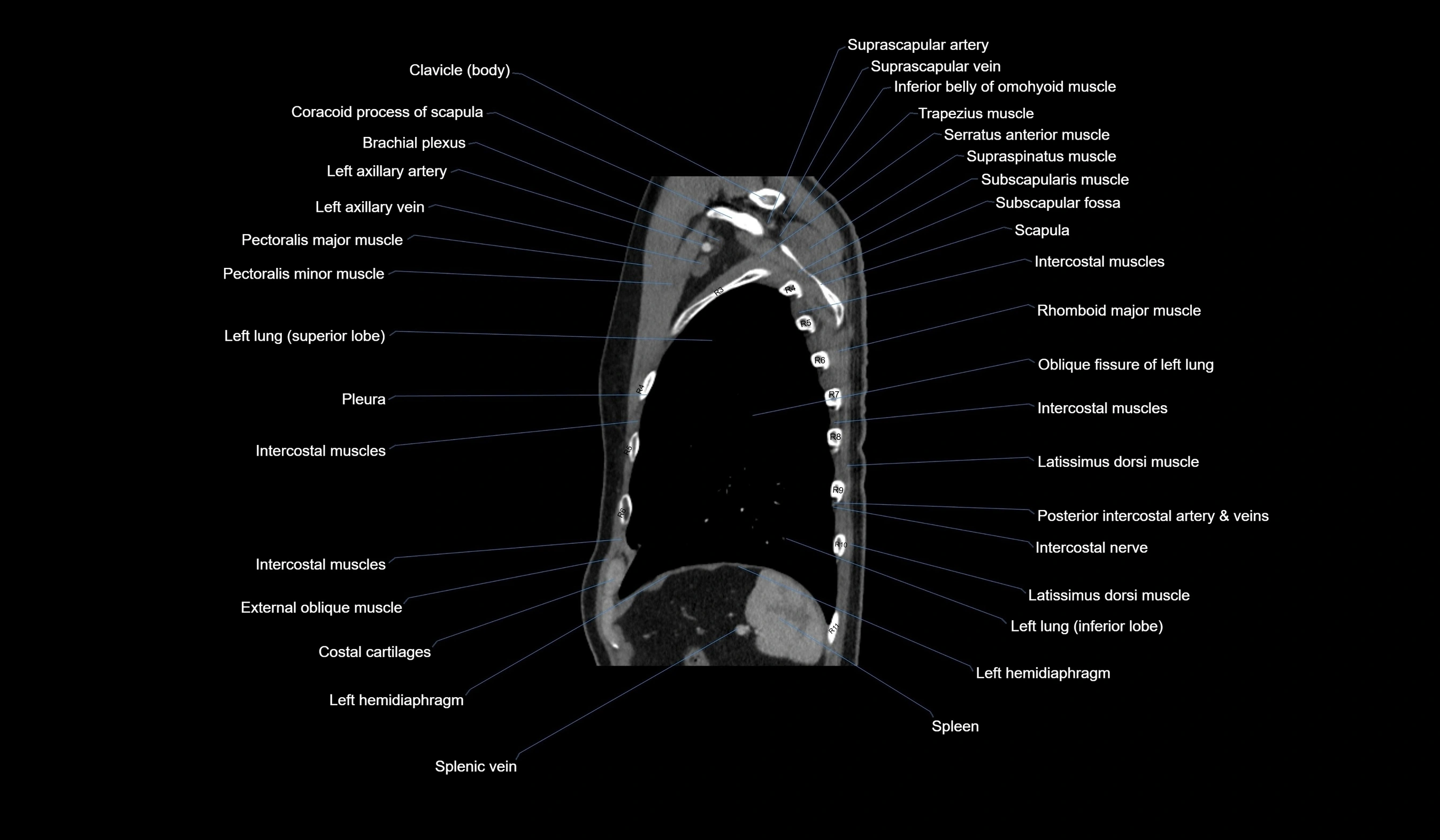 CT chest (thorax) labelled sagittal cross sectional anatomy radiology image-00117.webp